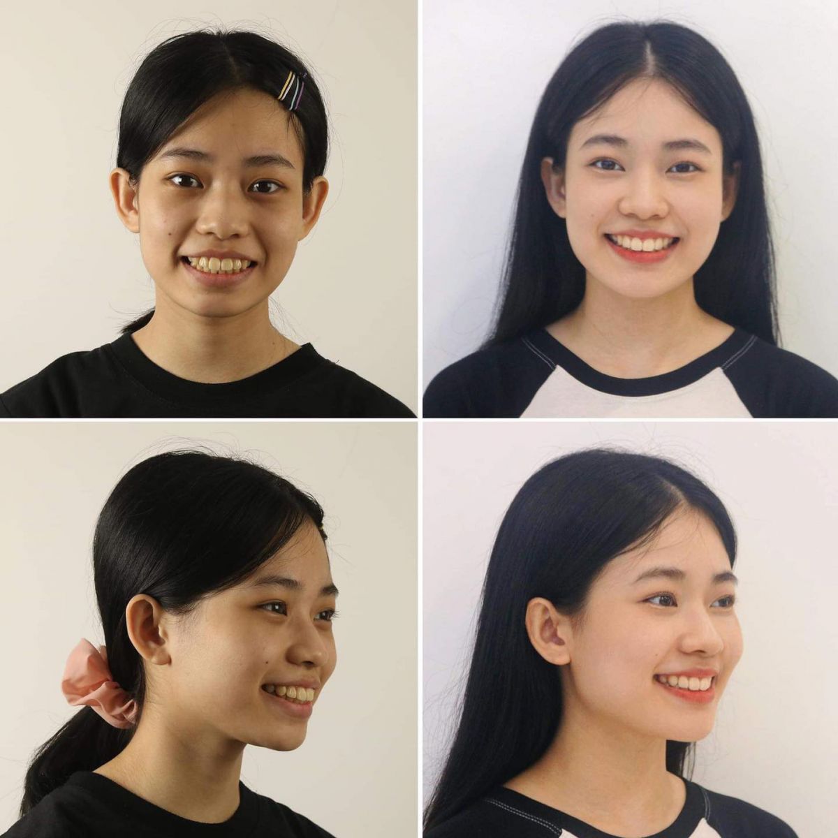 Dù không đem lại tính thẩm mỹ cao nhưng niềng răng mắc cài kim loại vẫn rất được ưa chuộng 