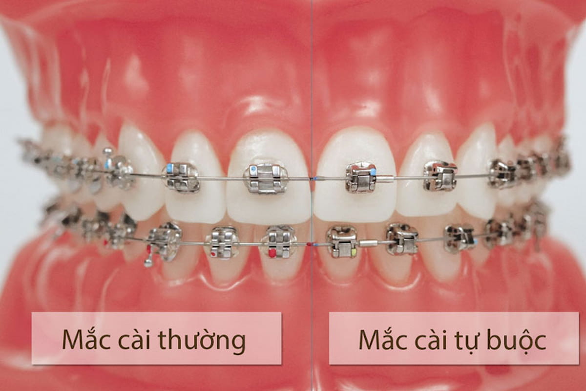 Dạng mắc cài kim loại tự buộc