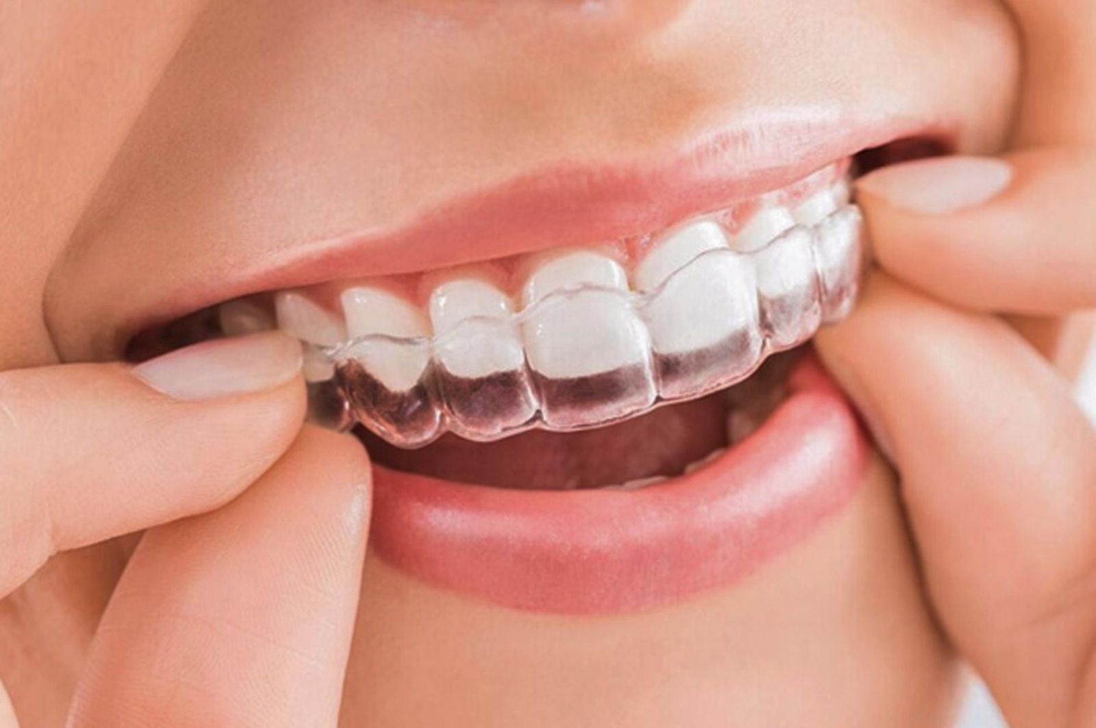 Niềng răng trong suốt sử dụng khay niềng bằng nhựa tạo cảm giác vô hình khi sử dụng