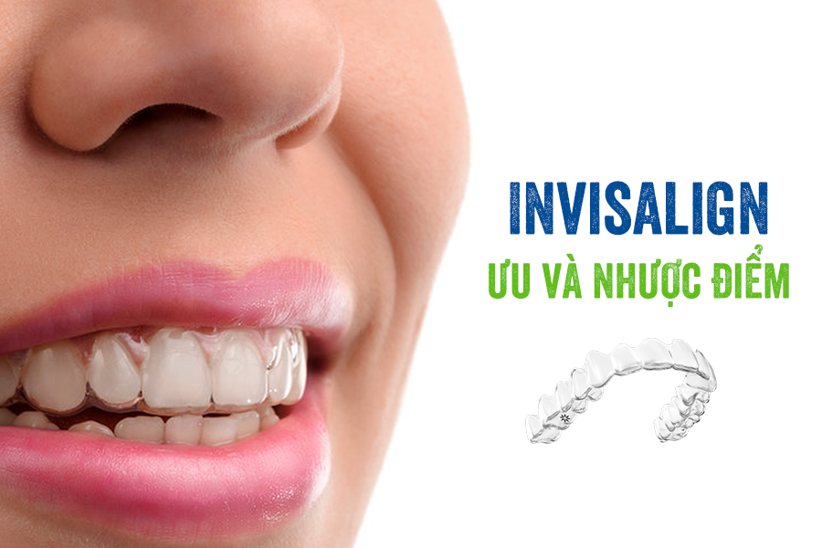 Những ưu điểm của niềng răng trong suốt