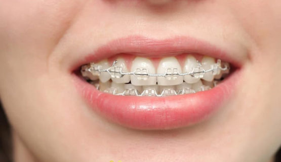 Mắc cài kim loại truyền thống thường sử dụng dây thun để cố định 