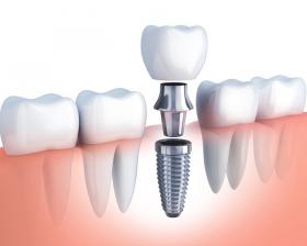 Implant Nha Khoa Phương Pháp Hiệu Quả Cho Người Mất Răng
