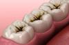 Những điều nên biết về sâu răng và điều trị răng sâu